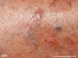 porokeratosis actinic