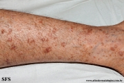 porokeratosis actinic