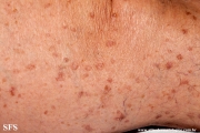 porokeratosis actinic