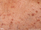 porokeratosis actinic