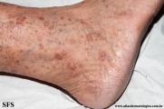 porokeratosis actinic