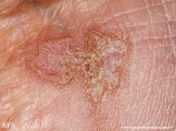 porokeratosis actinic