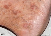 porokeratosis actinic