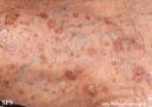 porokeratosis actinic