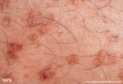 porokeratosis actinic