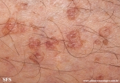 porokeratosis actinic
