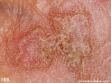 porokeratosis actinic