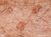 porokeratosis actinic