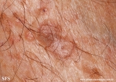 porokeratosis actinic