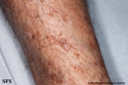 porokeratosis actinic