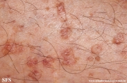 porokeratosis actinic