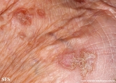 porokeratosis actinic