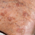 porokeratosis actinic
