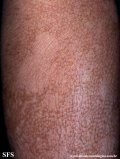pityriasis versicolor