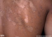 pityriasis versicolor