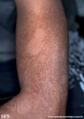 pityriasis versicolor