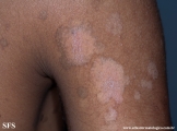 pityriasis versicolor