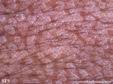 pityriasis versicolor