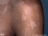pityriasis versicolor