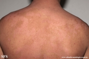 pityriasis versicolor