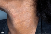 pityriasis versicolor