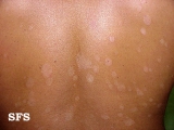 pityriasis versicolor