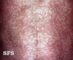 pityriasis versicolor