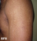 pityriasis versicolor