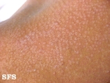 pityriasis versicolor