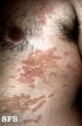 pityriasis versicolor