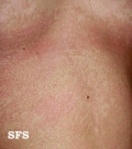 pityriasis versicolor