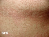 pityriasis versicolor