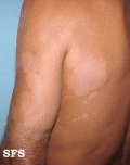 pityriasis versicolor