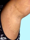 pityriasis versicolor