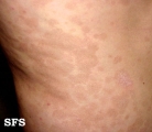 pityriasis versicolor