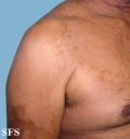 pityriasis versicolor