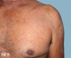 pityriasis versicolor
