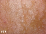 pityriasis versicolor