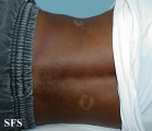 pityriasis versicolor