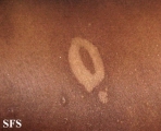pityriasis versicolor