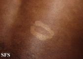 pityriasis versicolor