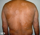 pityriasis versicolor