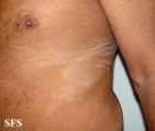 pityriasis versicolor