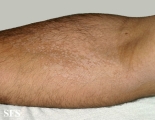 pityriasis versicolor