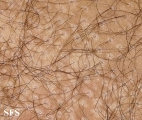 pityriasis versicolor