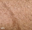 pityriasis versicolor