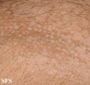 pityriasis versicolor