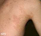 pityriasis versicolor