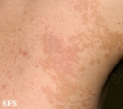 pityriasis versicolor