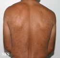 pityriasis versicolor